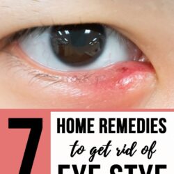 Eye Stye: Causes & 7 Best Home Remedies to Treat Eye Stye