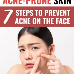 How to Treat Acne-Prone Skin: 7 Ways to Prevent Acne at-Home!