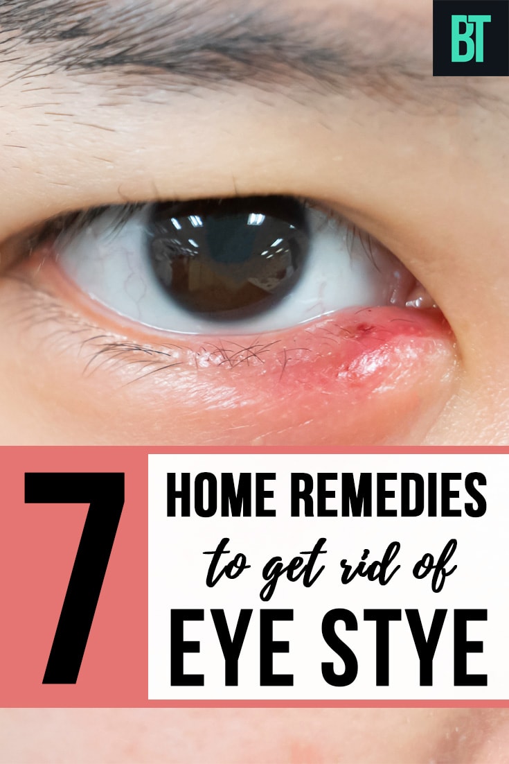 Eye Stye: Causes & 7 Best Home Remedies to Treat Eye Stye